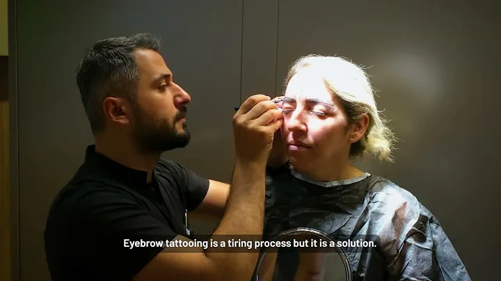 Anton's Hair Transplant Journey