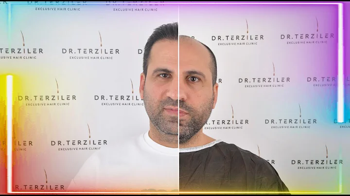 Ramazan'ın Saç Ekim Yolculuğu