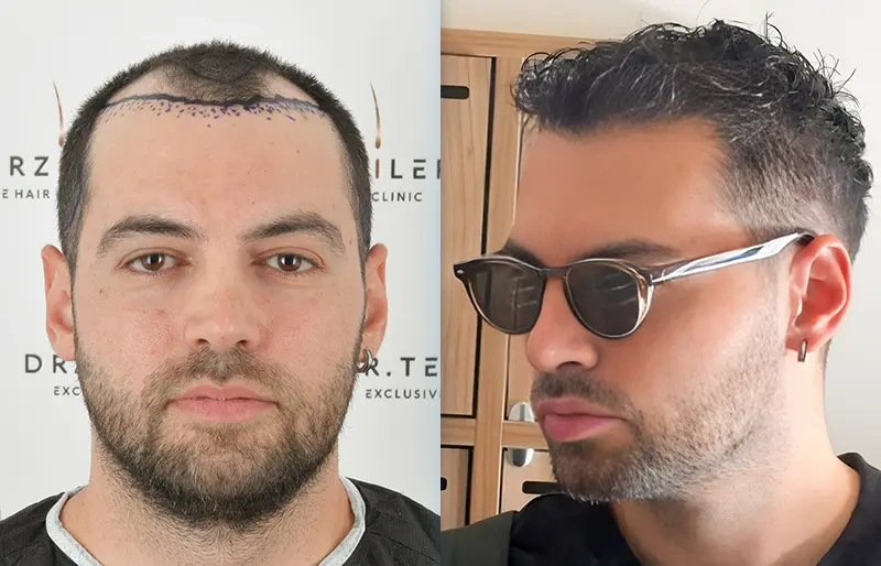 Before After 2