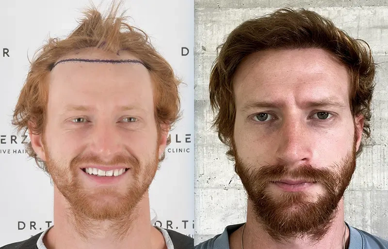 Before After 8