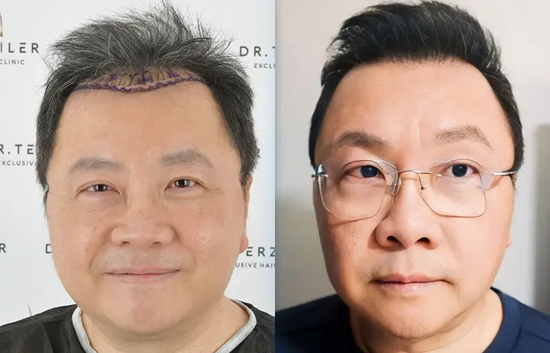 Before After 9