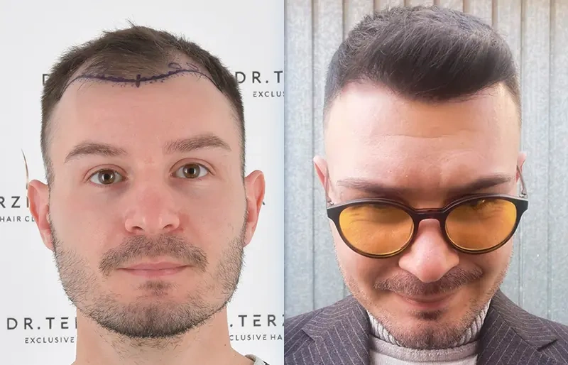 Before After 1