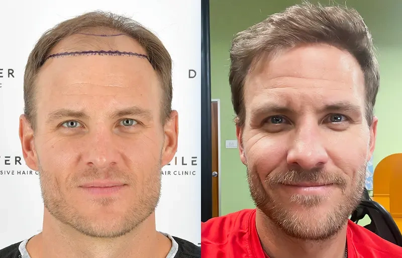 Before After 3