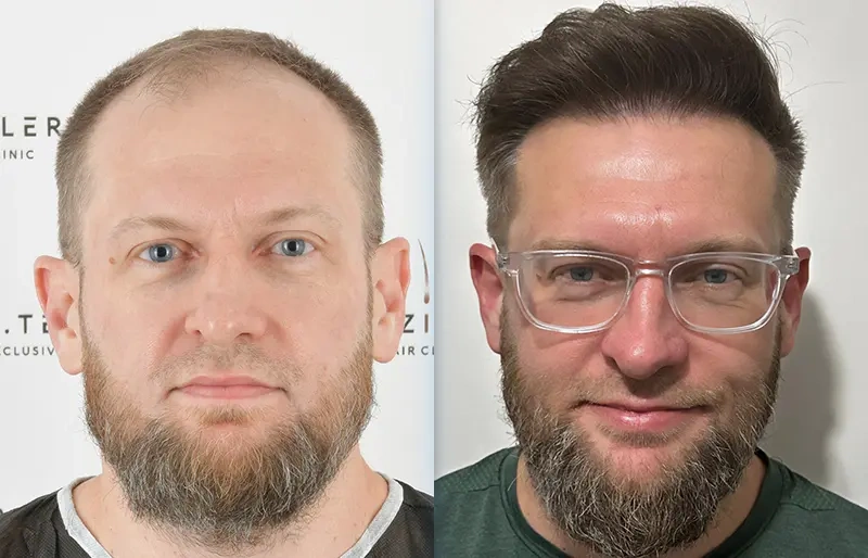 Before After 4