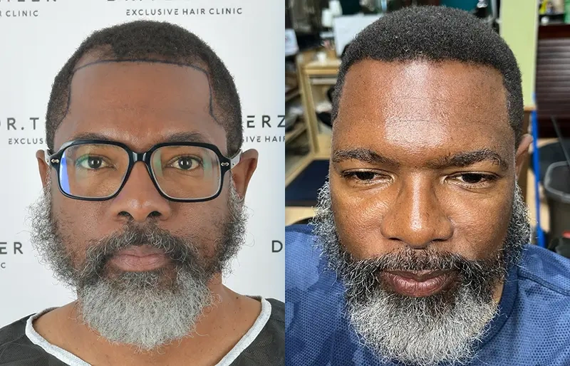 Before After 5