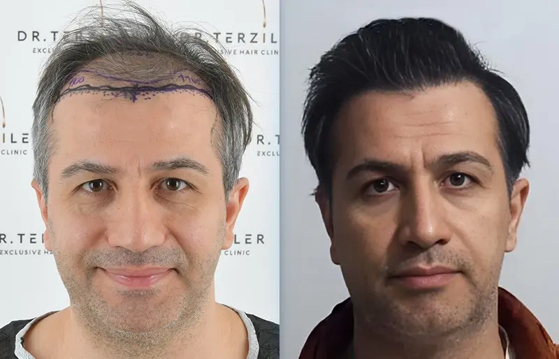 Before After 6