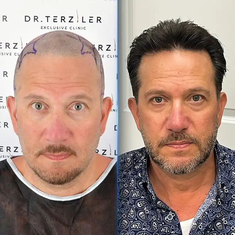 Before After 1