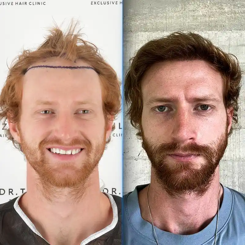 Before After 2