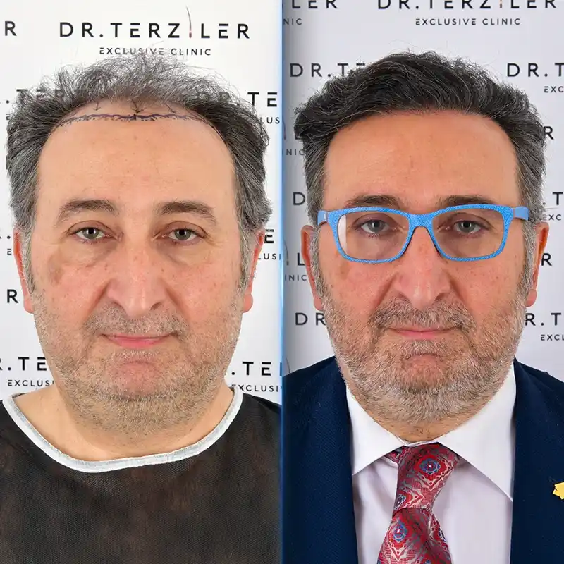 Before After 3