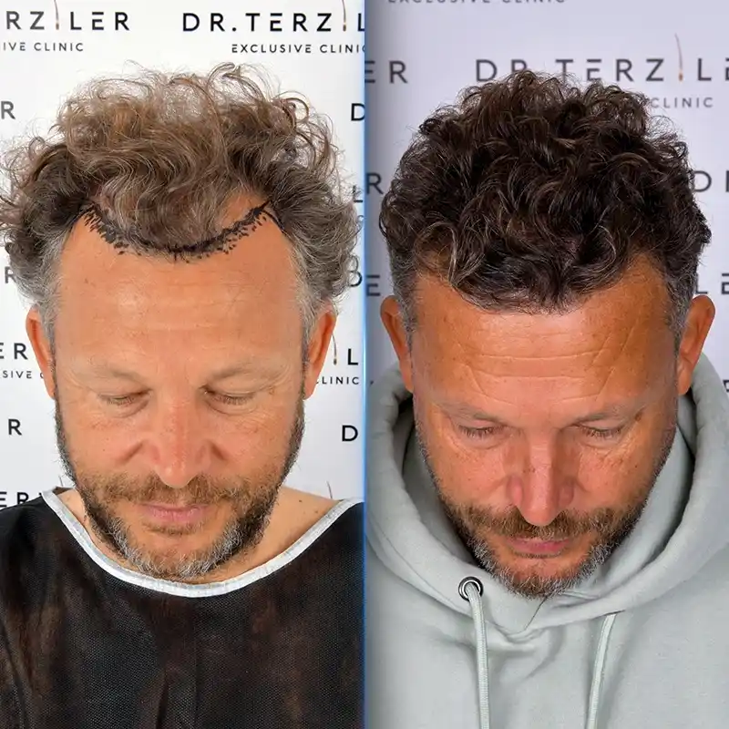 Before After 4
