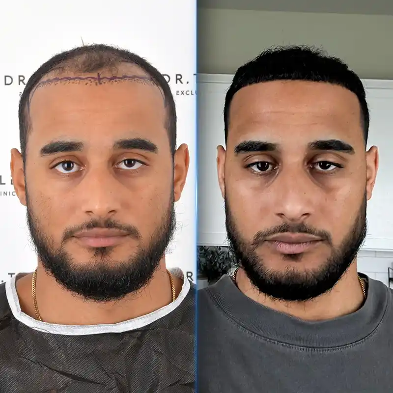 Before After 5
