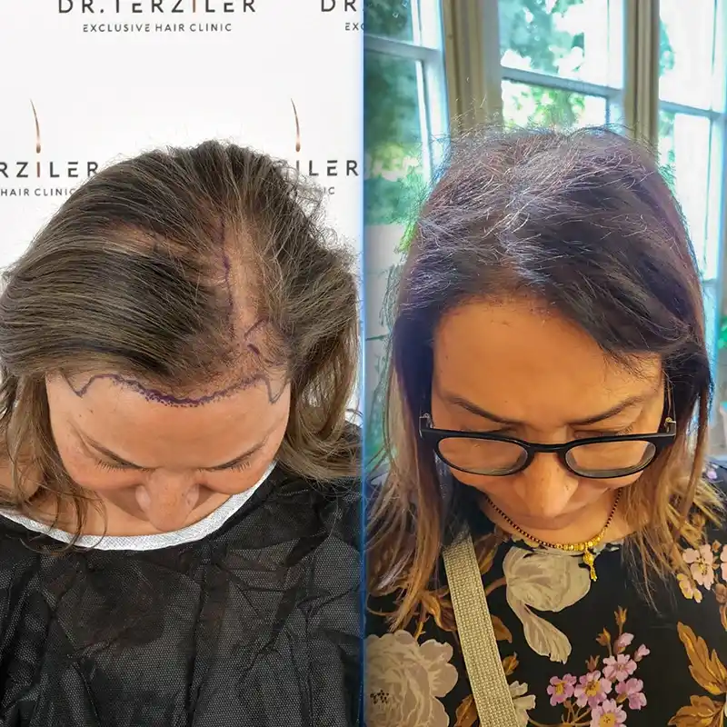 Before After 6